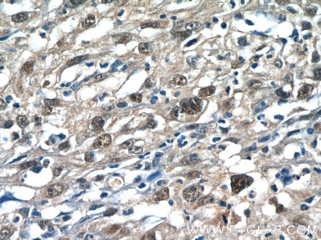 Immunohistochemistry (IHC) staining of human cervical cancer tissue using RPP25 Polyclonal antibody (15461-1-AP)