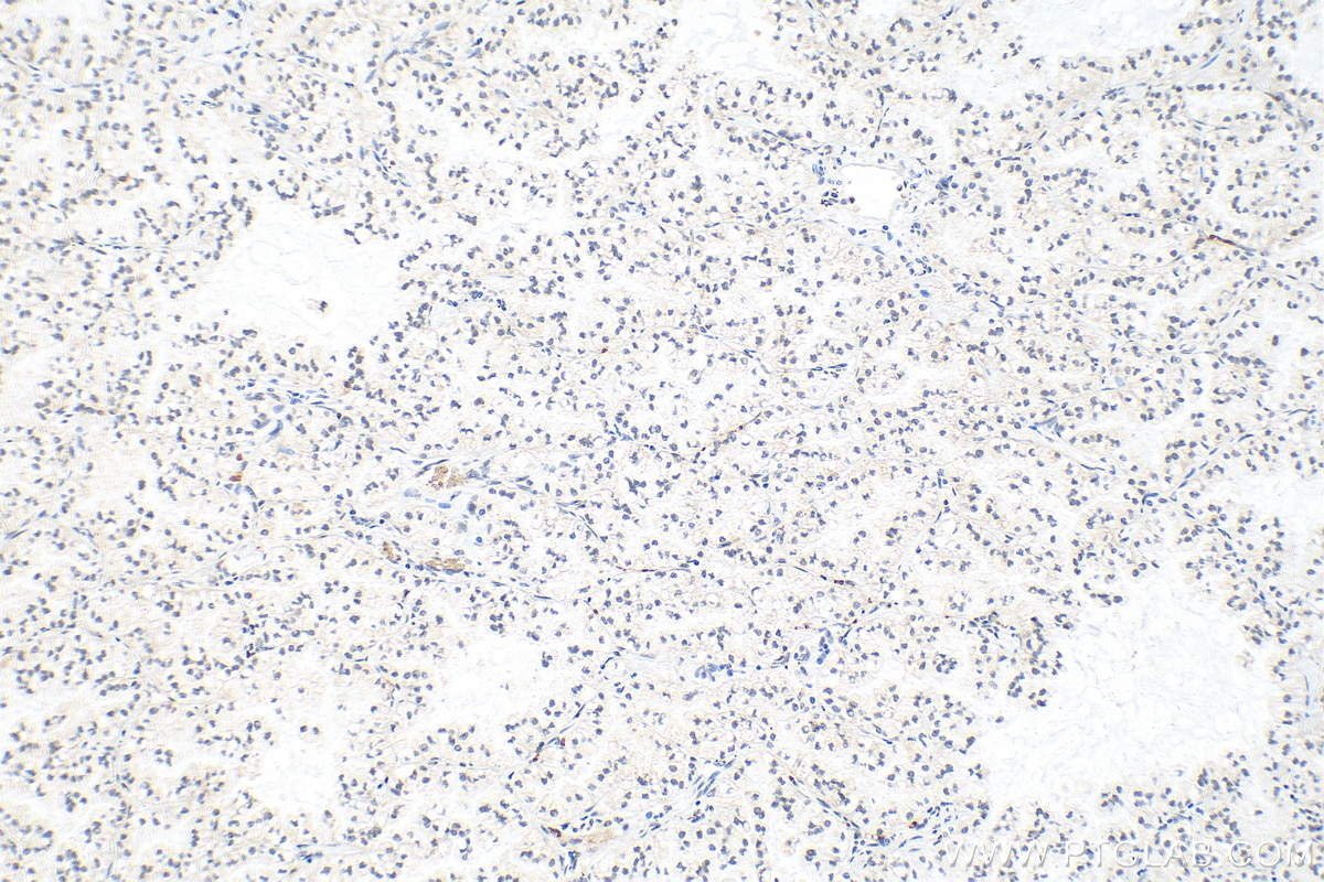 Immunohistochemistry (IHC) staining of human lung cancer tissue using RPP30 Polyclonal antibody (18435-1-AP)