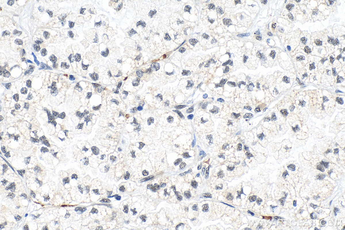 IHC staining of human lung cancer using 18435-1-AP