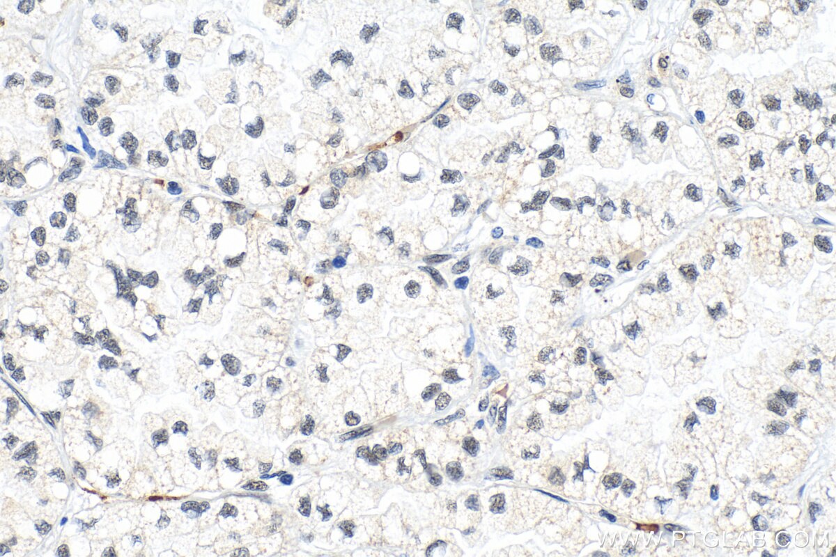 Immunohistochemistry (IHC) staining of human lung cancer tissue using RPP30 Polyclonal antibody (18435-1-AP)