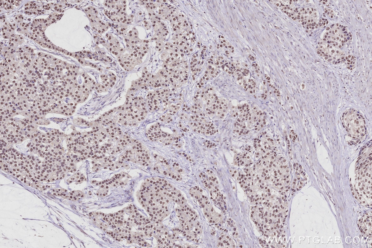 Immunohistochemistry (IHC) staining of human stomach cancer tissue using RPRD1B Polyclonal antibody (24542-1-AP)