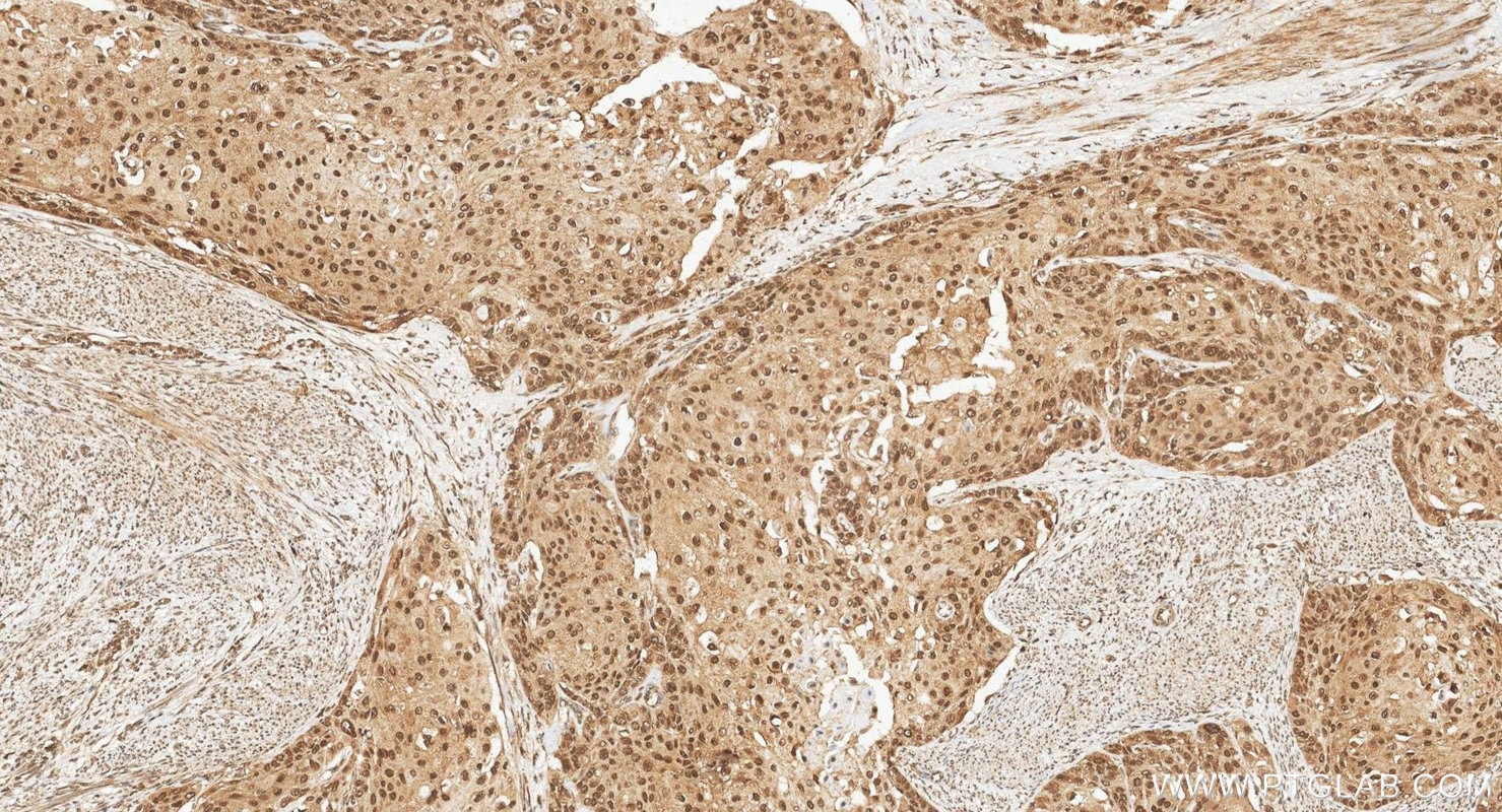 Immunohistochemistry (IHC) staining of human cervical cancer tissue using RPRD1B Polyclonal antibody (24542-1-AP)