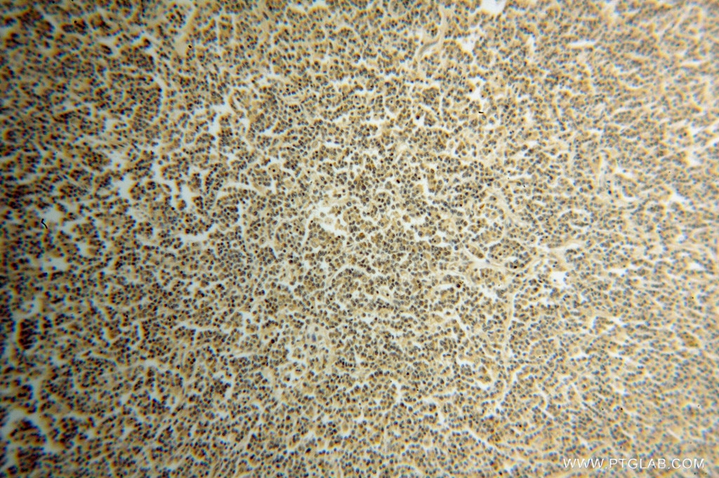 IHC staining of human lymphoma using 14894-1-AP