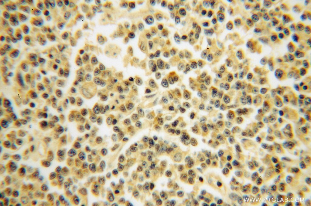 Immunohistochemistry (IHC) staining of human lymphoma tissue using RPS10 Polyclonal antibody (14894-1-AP)