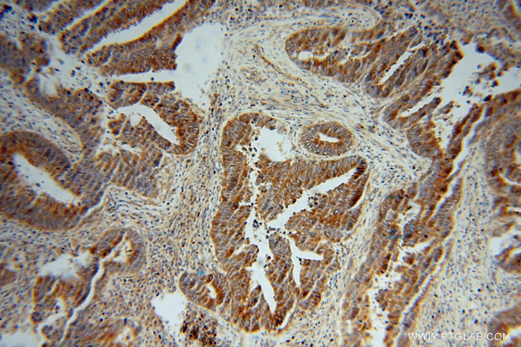 Immunohistochemistry (IHC) staining of human colon cancer tissue using RPS12 Polyclonal antibody (16490-1-AP)