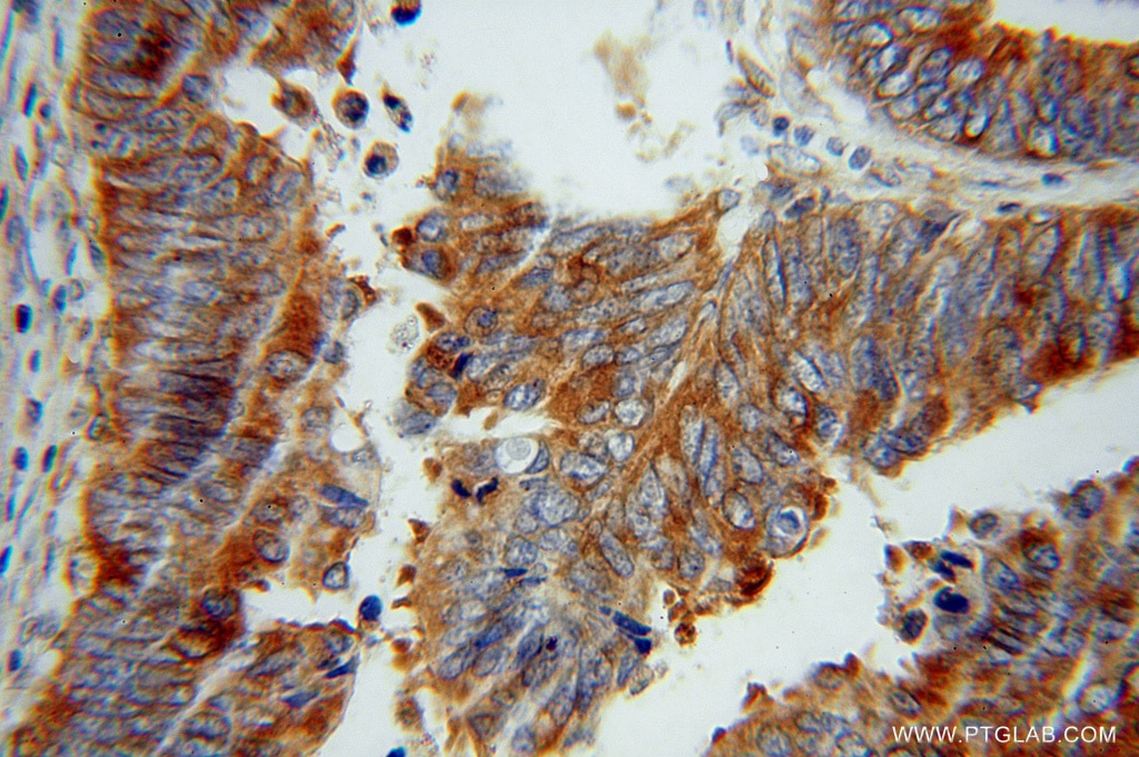 Immunohistochemistry (IHC) staining of human colon cancer tissue using RPS12 Polyclonal antibody (16490-1-AP)