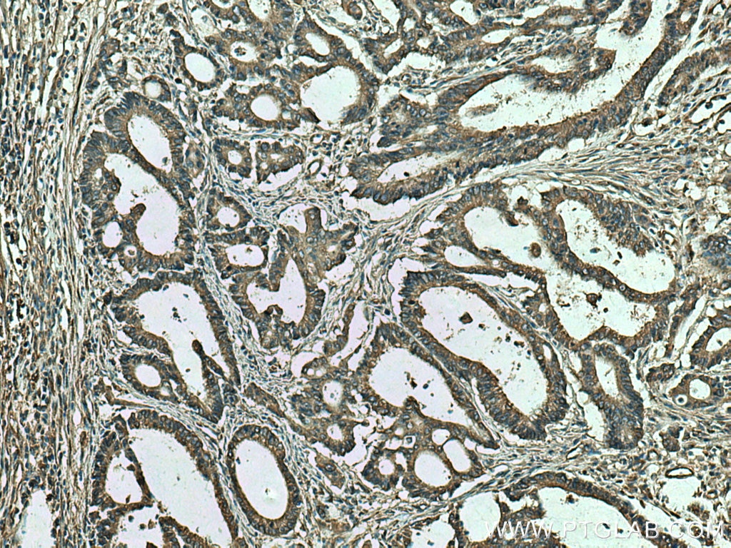 Immunohistochemistry (IHC) staining of human colon cancer tissue using RPS12 Monoclonal antibody (67683-1-Ig)