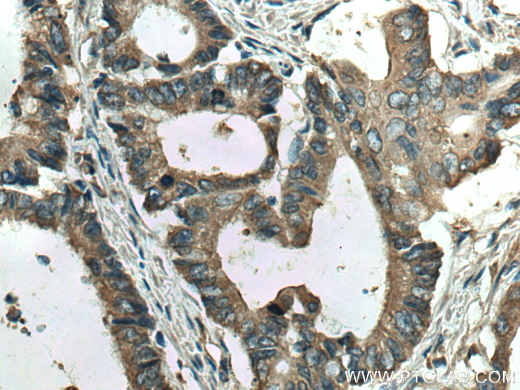 Immunohistochemistry (IHC) staining of human colon cancer tissue using RPS12 Monoclonal antibody (67683-1-Ig)