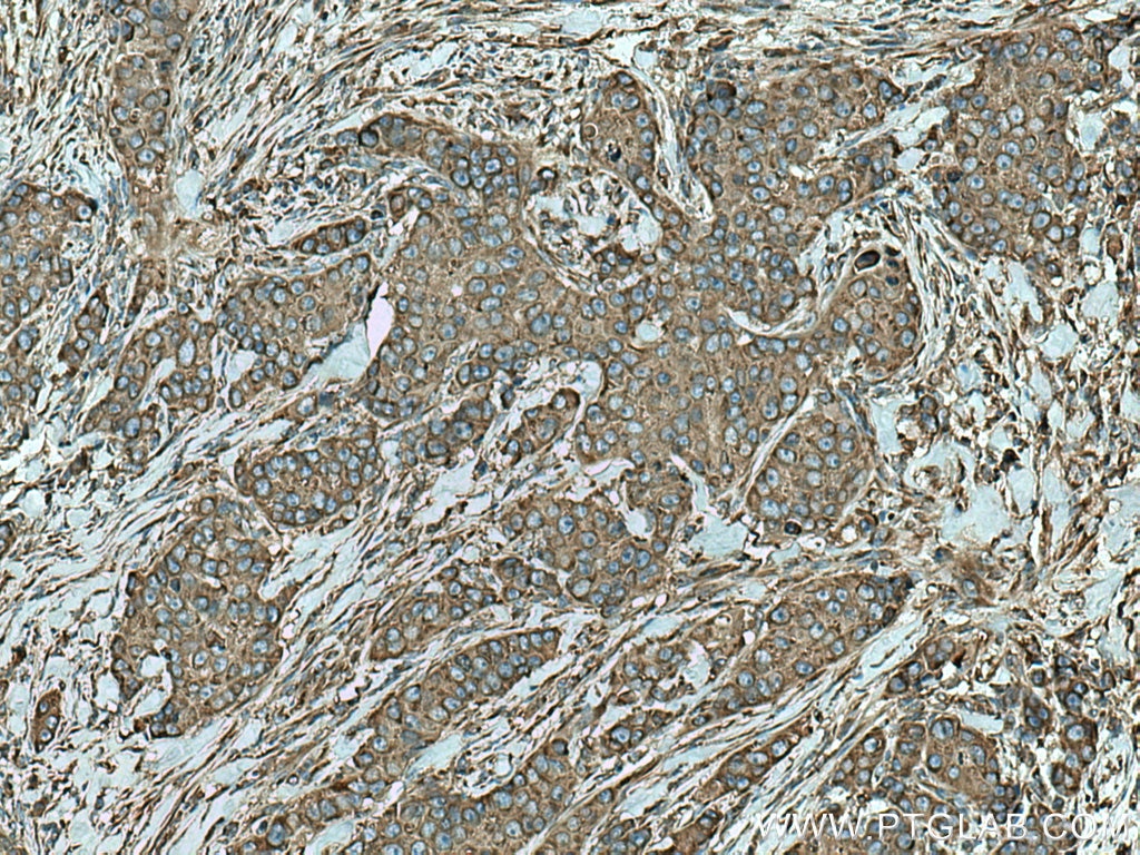 Immunohistochemistry (IHC) staining of human breast cancer tissue using RPS12 Monoclonal antibody (67683-1-Ig)