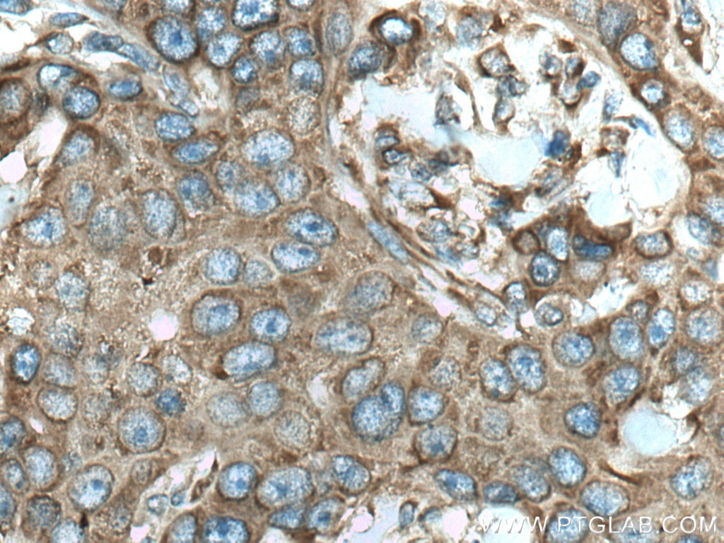 Immunohistochemistry (IHC) staining of human breast cancer tissue using RPS12 Monoclonal antibody (67683-1-Ig)