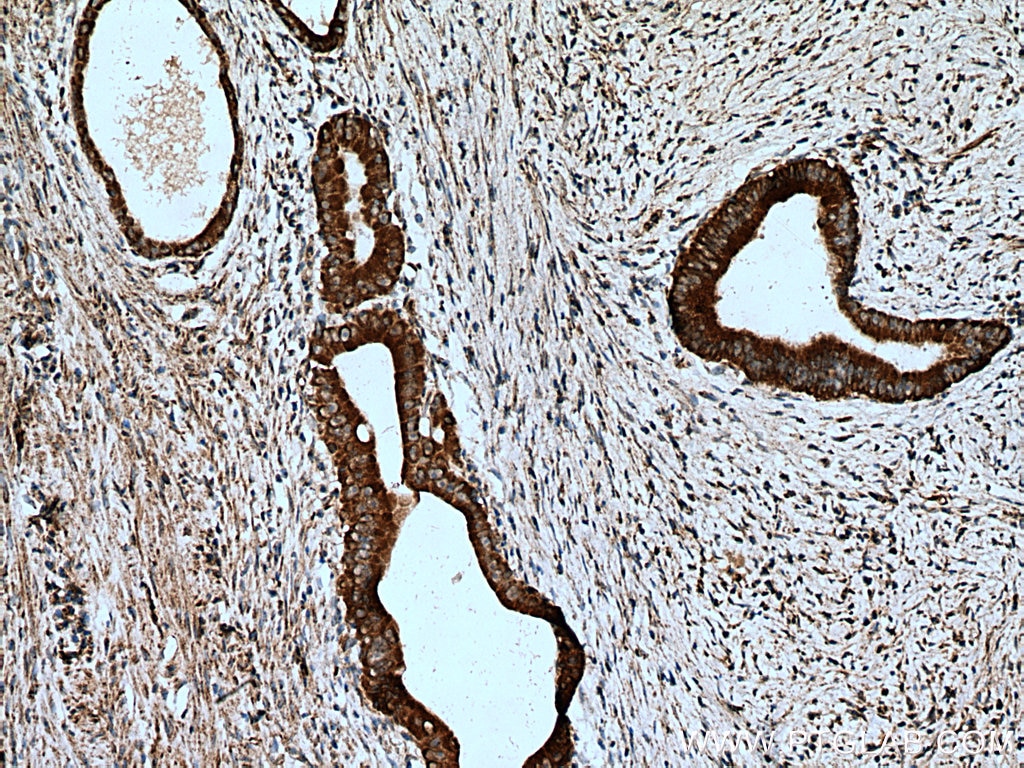 IHC staining of human colon cancer using 16680-1-AP