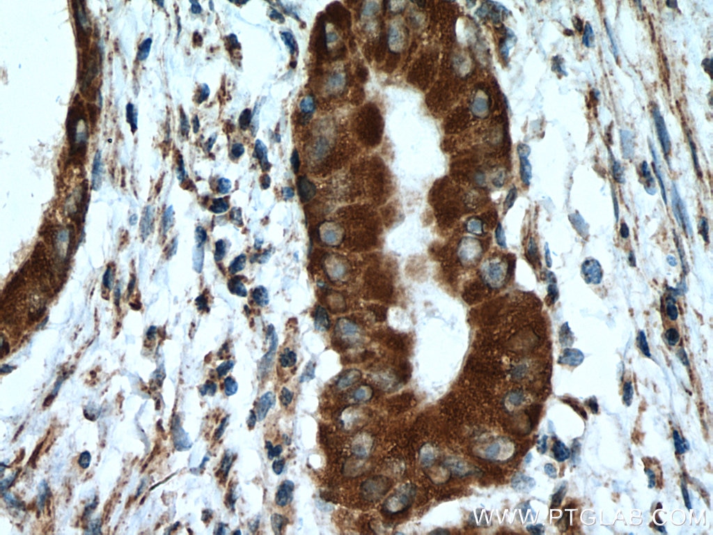 Immunohistochemistry (IHC) staining of human colon cancer tissue using RPS13 Polyclonal antibody (16680-1-AP)