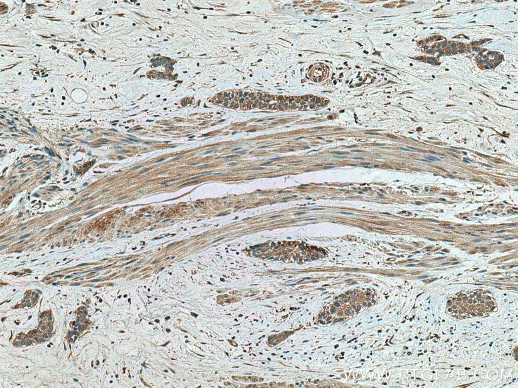 IHC staining of human urothelial carcinoma using 67566-1-Ig