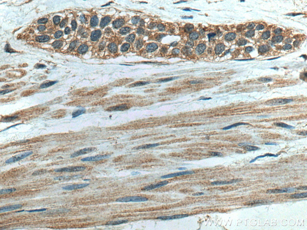 Immunohistochemistry (IHC) staining of human urothelial carcinoma tissue using RPS14 Monoclonal antibody (67566-1-Ig)