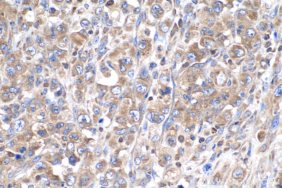 Immunohistochemistry (IHC) staining of human lymphoma tissue using RPS15 Polyclonal antibody (14957-1-AP)
