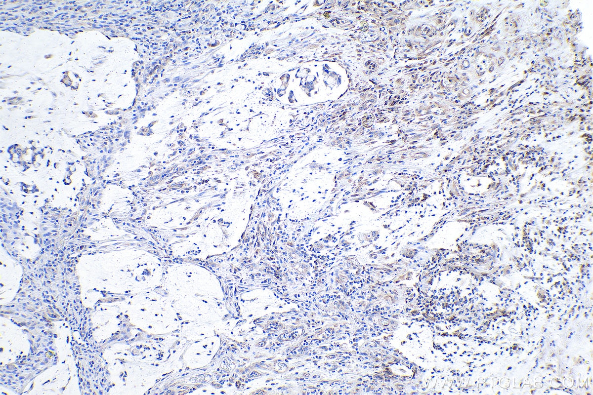 Immunohistochemistry (IHC) staining of human colon cancer tissue using RPS15 Polyclonal antibody (14957-1-AP)