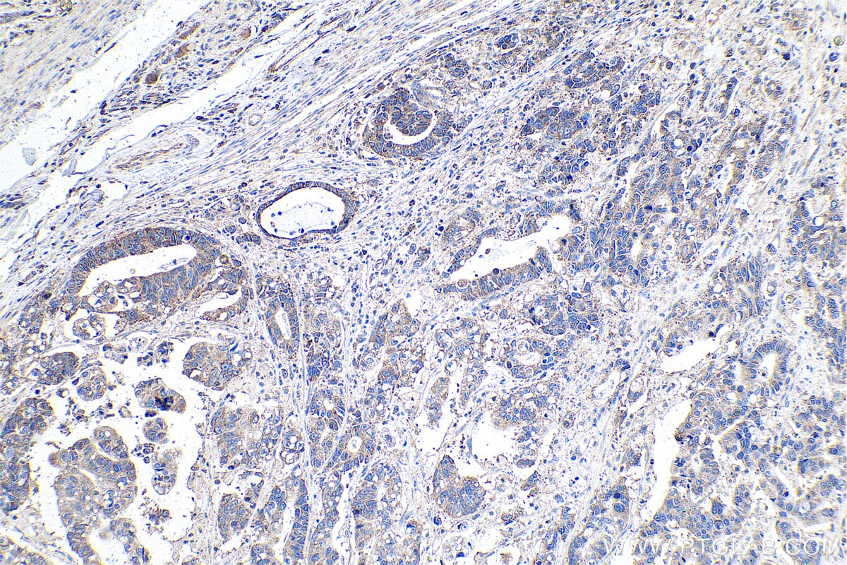 Immunohistochemistry (IHC) staining of human stomach cancer tissue using RPS15 Polyclonal antibody (14957-1-AP)