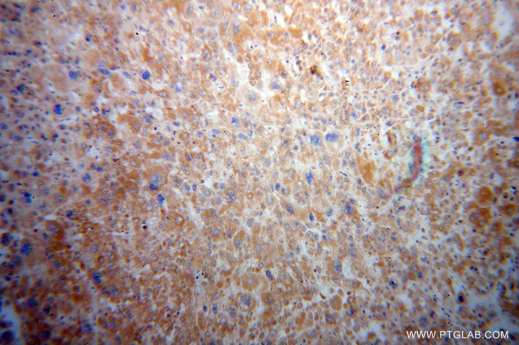 Immunohistochemistry (IHC) staining of human liver cancer tissue using RPS15 Polyclonal antibody (14957-1-AP)