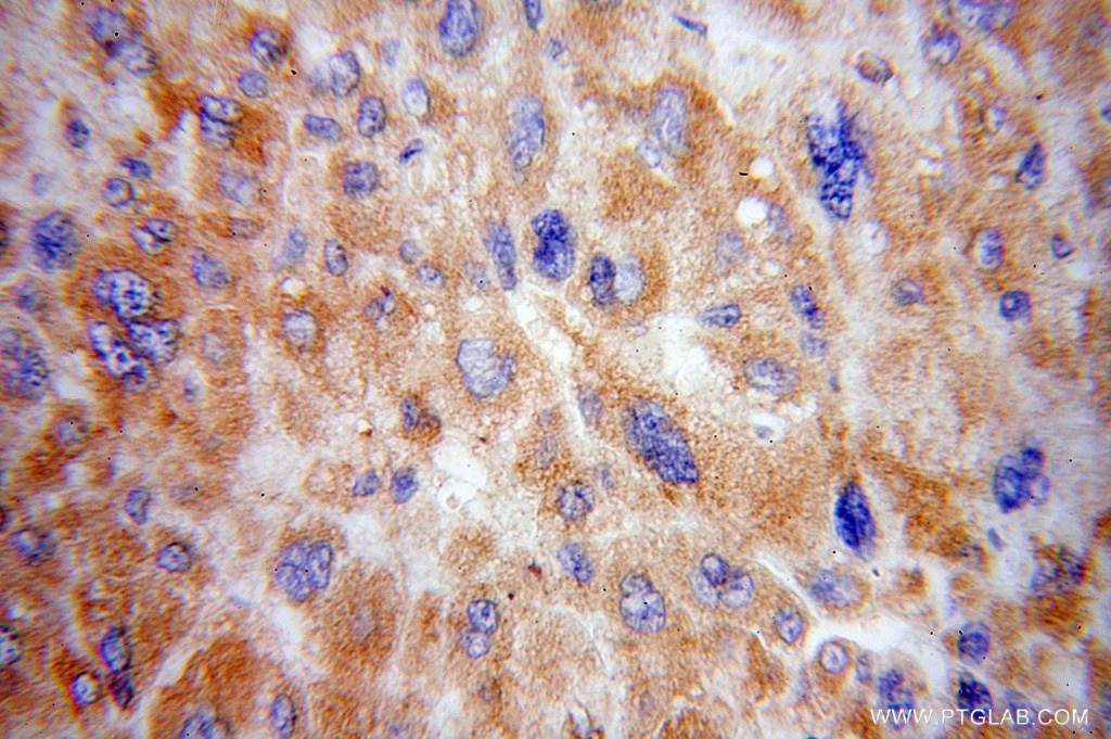 Immunohistochemistry (IHC) staining of human liver cancer tissue using RPS15 Polyclonal antibody (14957-1-AP)