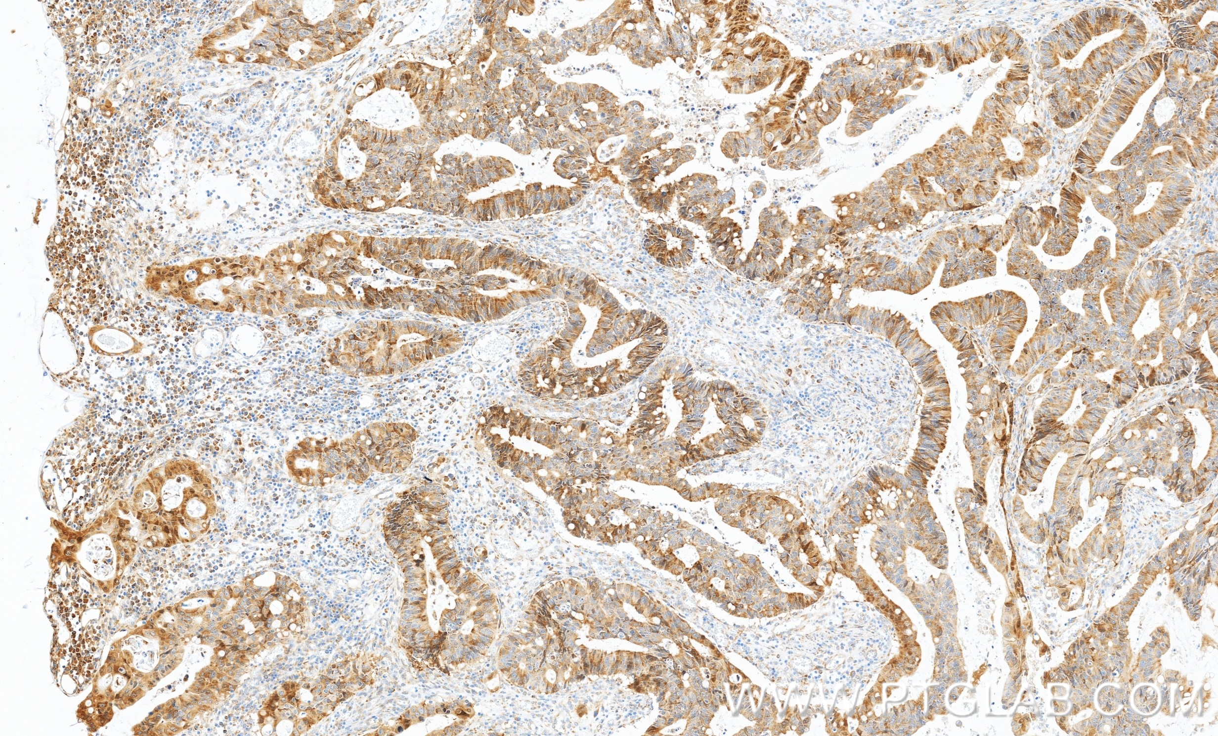 Immunohistochemistry (IHC) staining of human colon cancer tissue using RPS15 Recombinant monoclonal antibody (86318-2-RR)