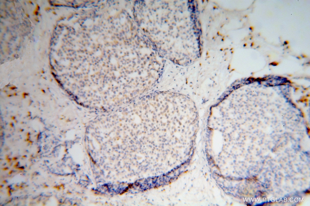 Immunohistochemistry (IHC) staining of human breast cancer tissue using RPS16 Polyclonal antibody (15603-1-AP)