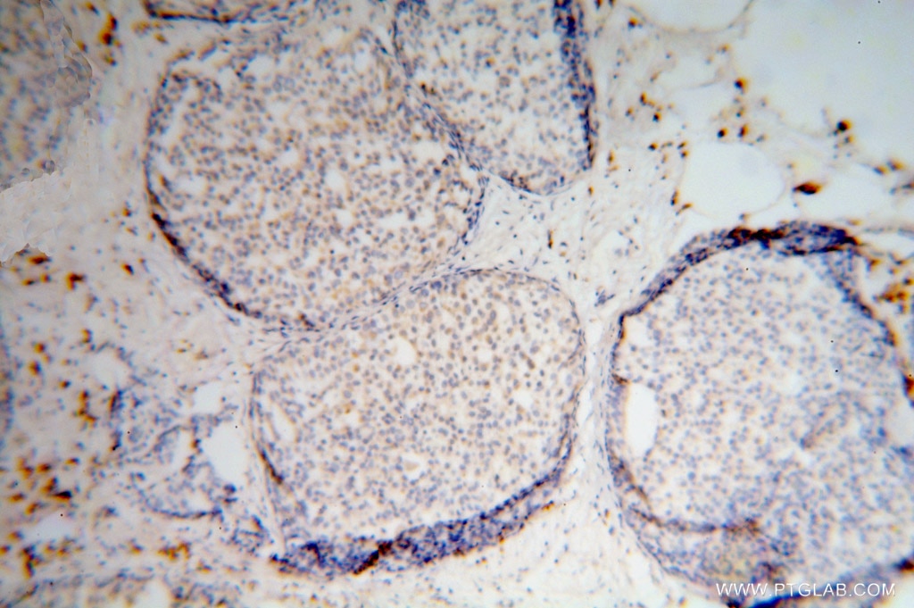 IHC staining of human breast cancer using 15603-1-AP