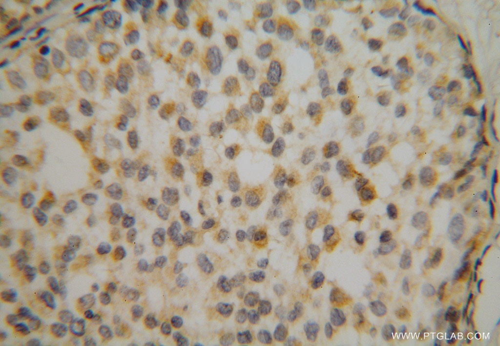 IHC staining of human breast cancer using 15603-1-AP