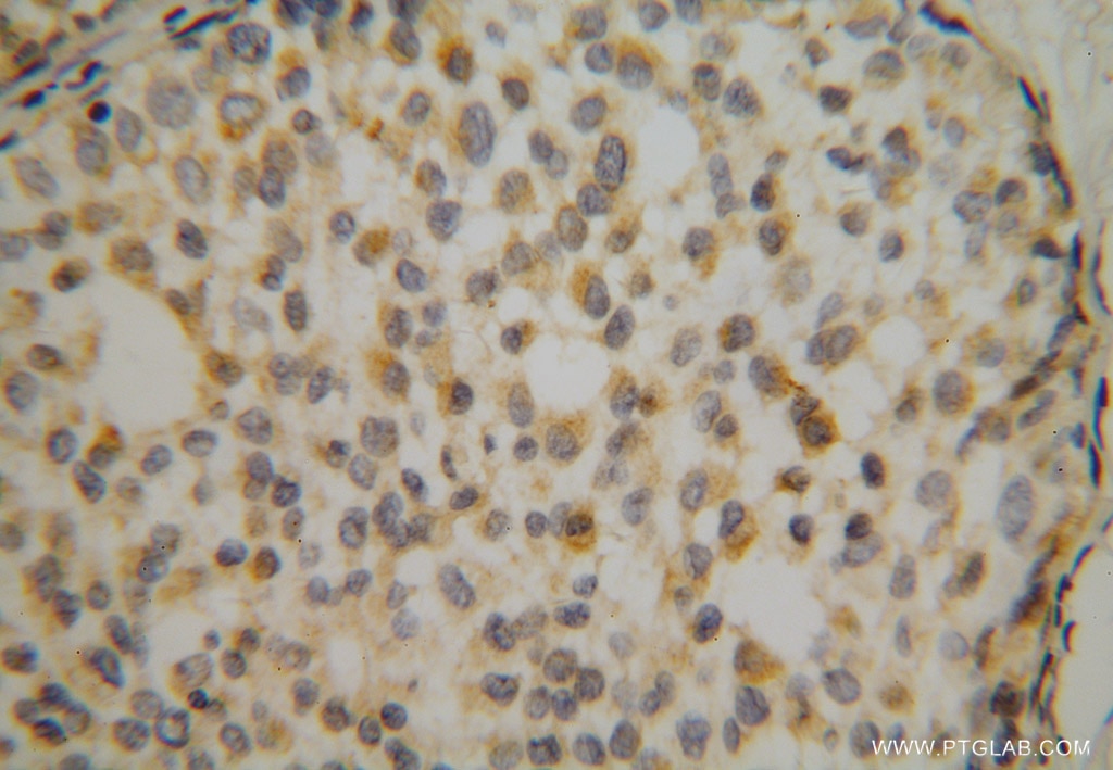 Immunohistochemistry (IHC) staining of human breast cancer tissue using RPS16 Polyclonal antibody (15603-1-AP)