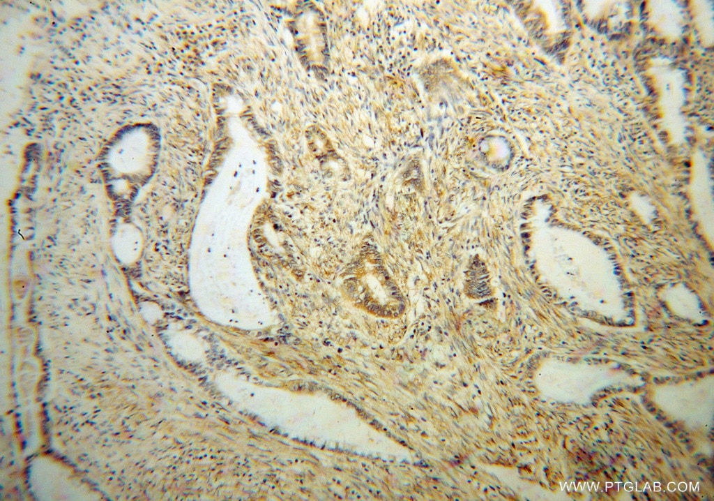 Immunohistochemistry (IHC) staining of human colon cancer tissue using RPS19 Polyclonal antibody (15085-1-AP)