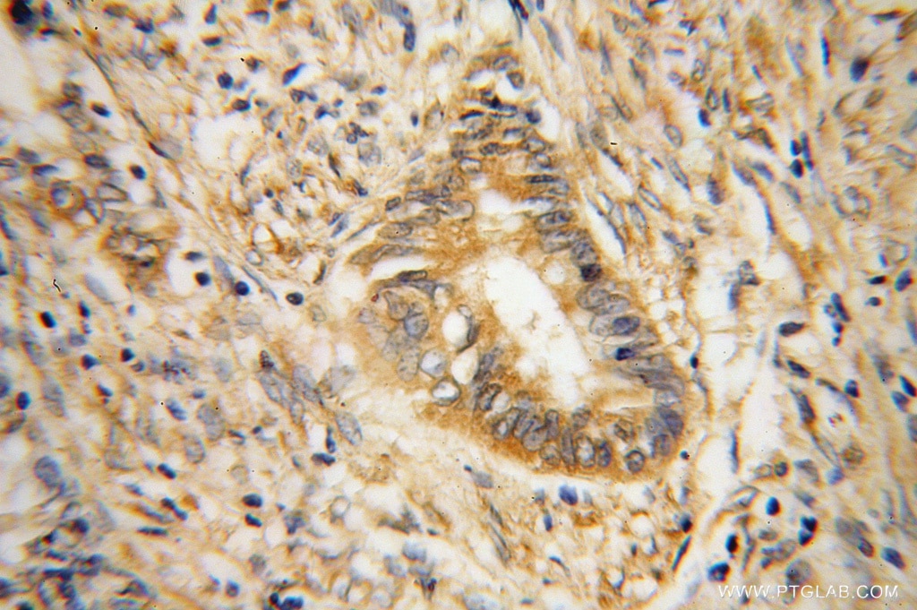 Immunohistochemistry (IHC) staining of human colon cancer tissue using RPS19 Polyclonal antibody (15085-1-AP)