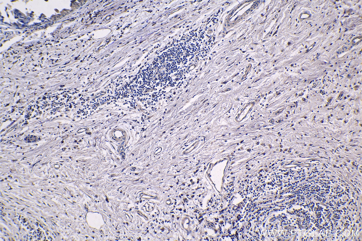 Immunohistochemistry (IHC) staining of human breast cancer tissue using RPS20 Monoclonal antibody (68270-1-Ig)