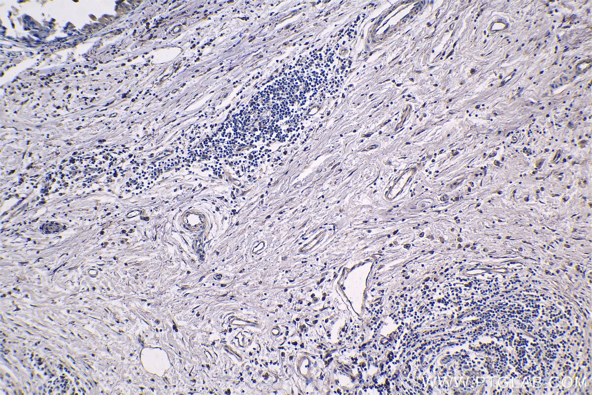 Immunohistochemistry (IHC) staining of human breast cancer tissue using RPS20 Monoclonal antibody (68270-1-Ig)