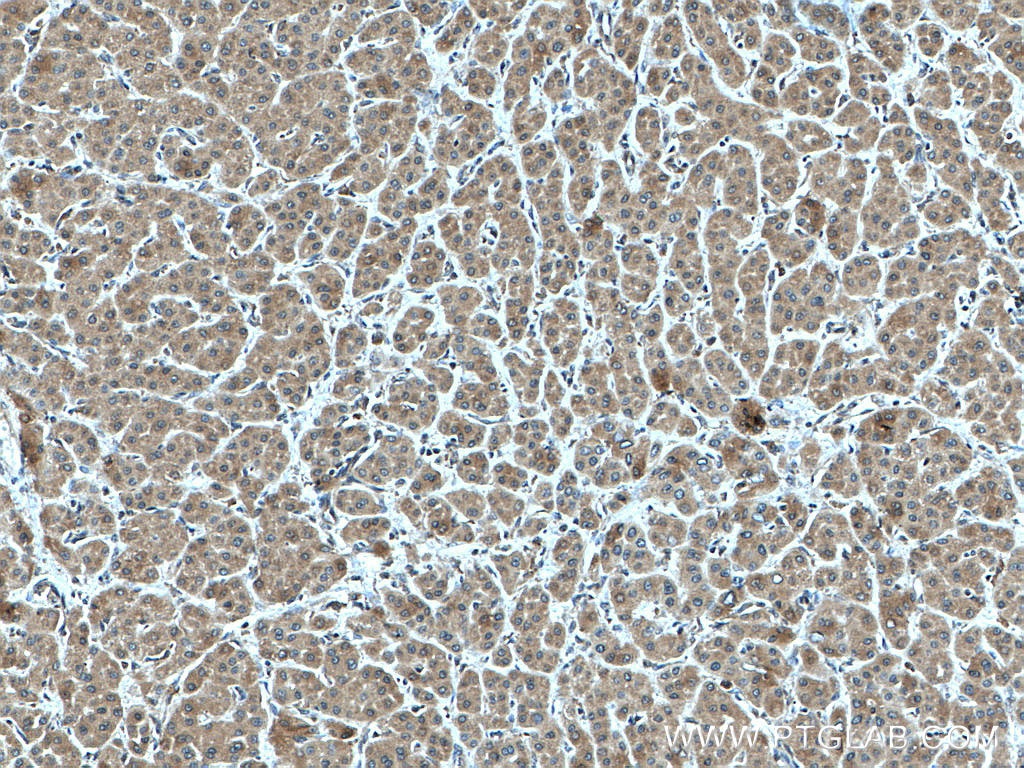 Immunohistochemistry (IHC) staining of human liver cancer tissue using RPS21 Polyclonal antibody (16946-1-AP)