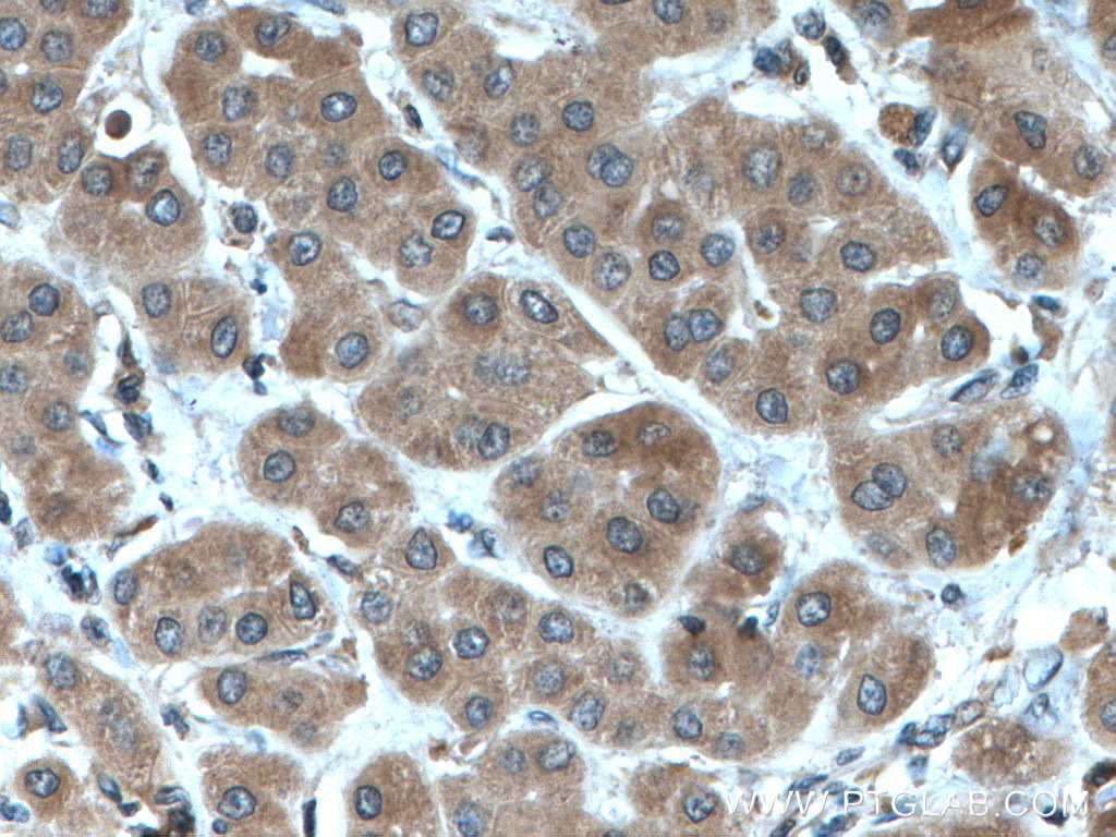 Immunohistochemistry (IHC) staining of human liver cancer tissue using RPS21 Polyclonal antibody (16946-1-AP)