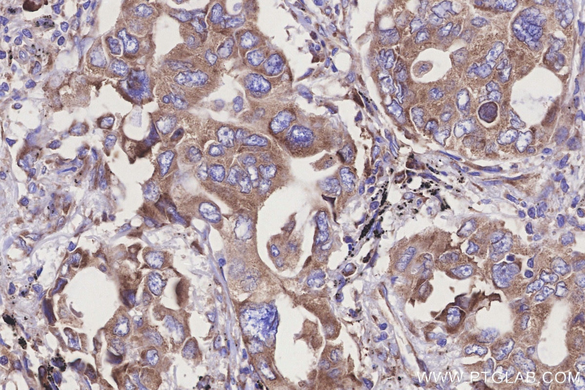 Immunohistochemistry (IHC) staining of human lung cancer tissue using RPS23 Polyclonal antibody (29834-1-AP)