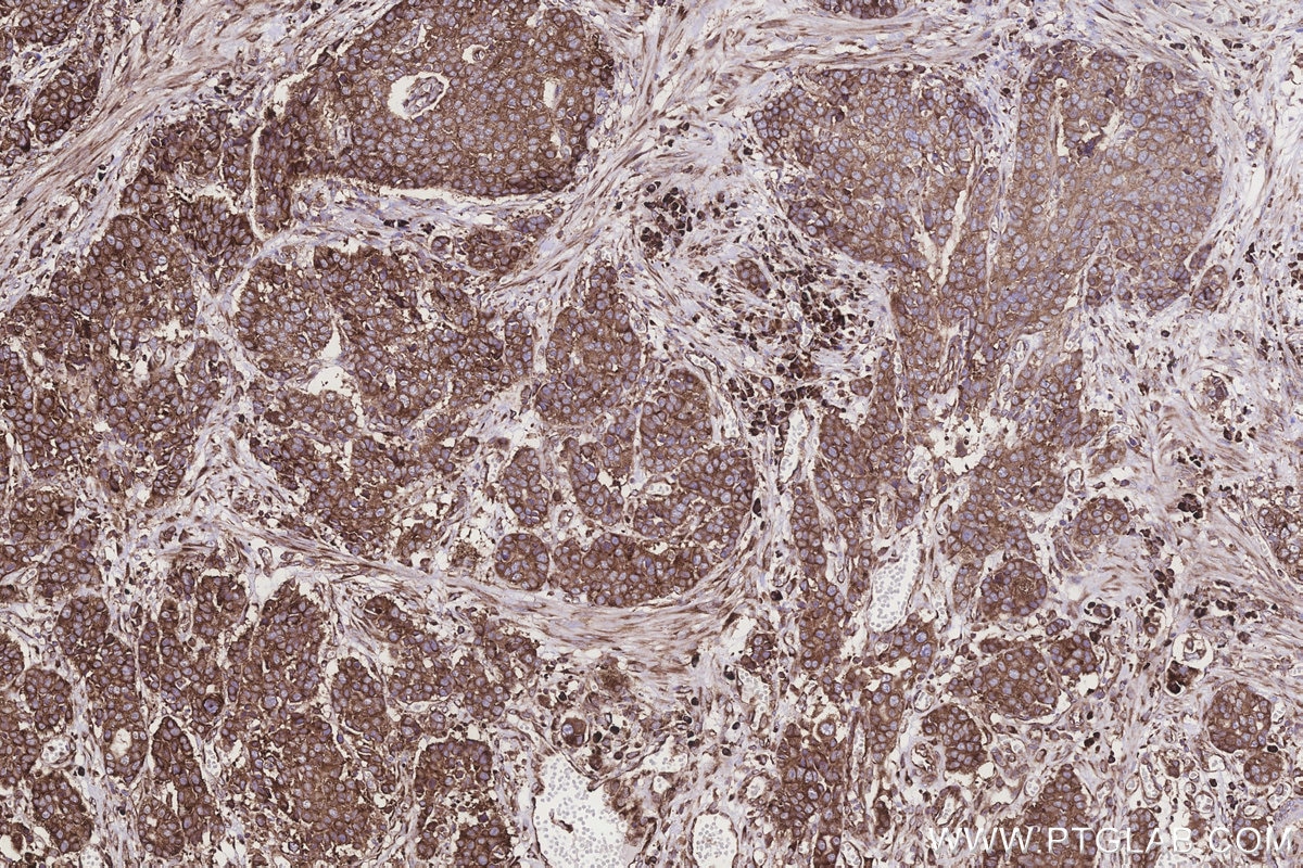 Immunohistochemistry (IHC) staining of human stomach cancer tissue using RPS23 Polyclonal antibody (29834-1-AP)
