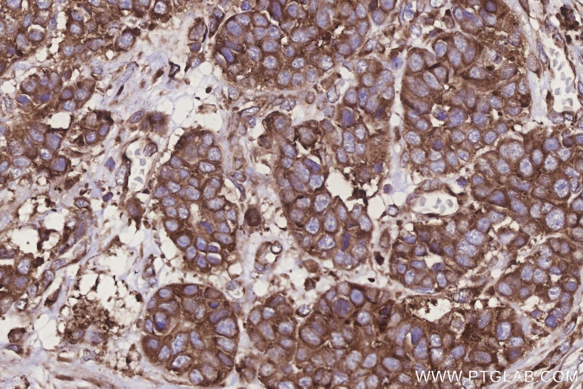Immunohistochemistry (IHC) staining of human stomach cancer tissue using RPS23 Polyclonal antibody (29834-1-AP)