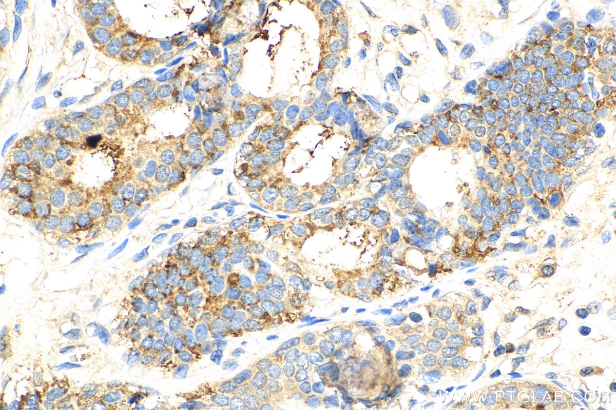 Immunohistochemistry (IHC) staining of human breast cancer tissue using RPS25 Polyclonal antibody (23599-1-AP)