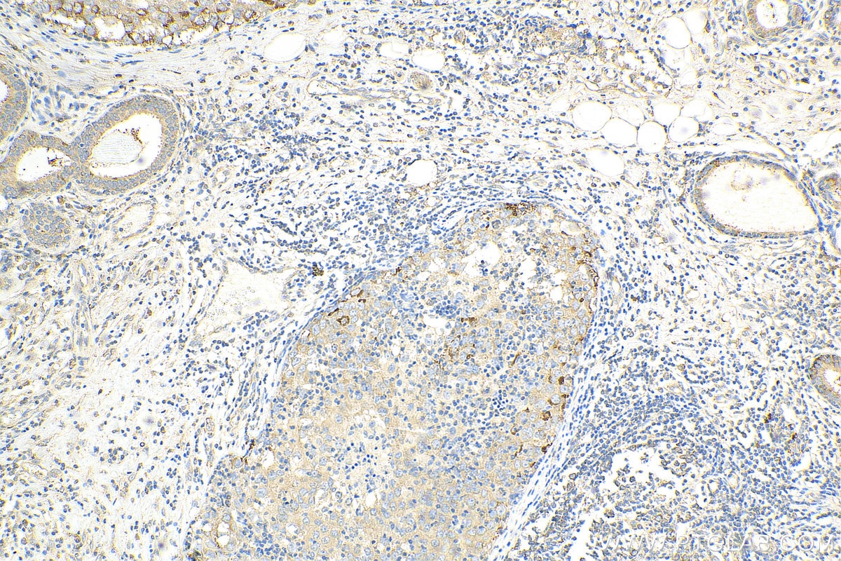 Immunohistochemistry (IHC) staining of human breast cancer tissue using RPS25 Polyclonal antibody (23599-1-AP)