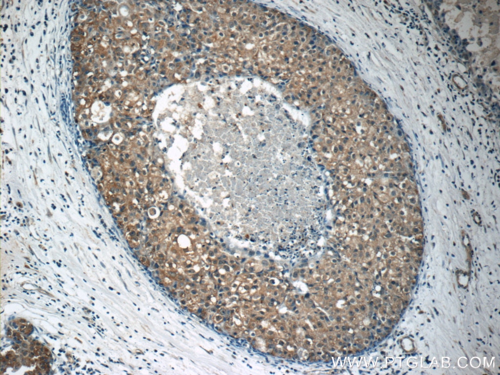 Immunohistochemistry (IHC) staining of human breast cancer tissue using RPS26 Polyclonal antibody (14909-1-AP)
