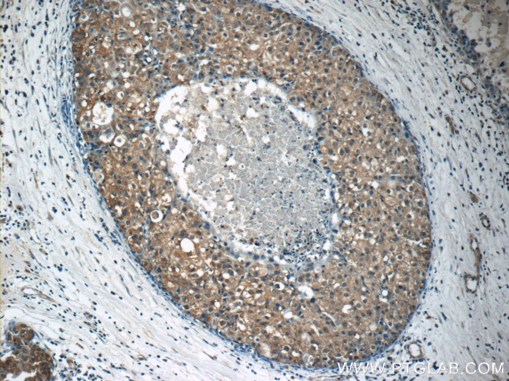 IHC staining of human breast cancer using 14909-1-AP