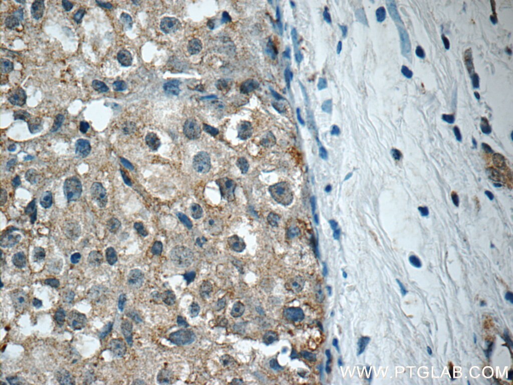 IHC staining of human breast cancer using 14909-1-AP