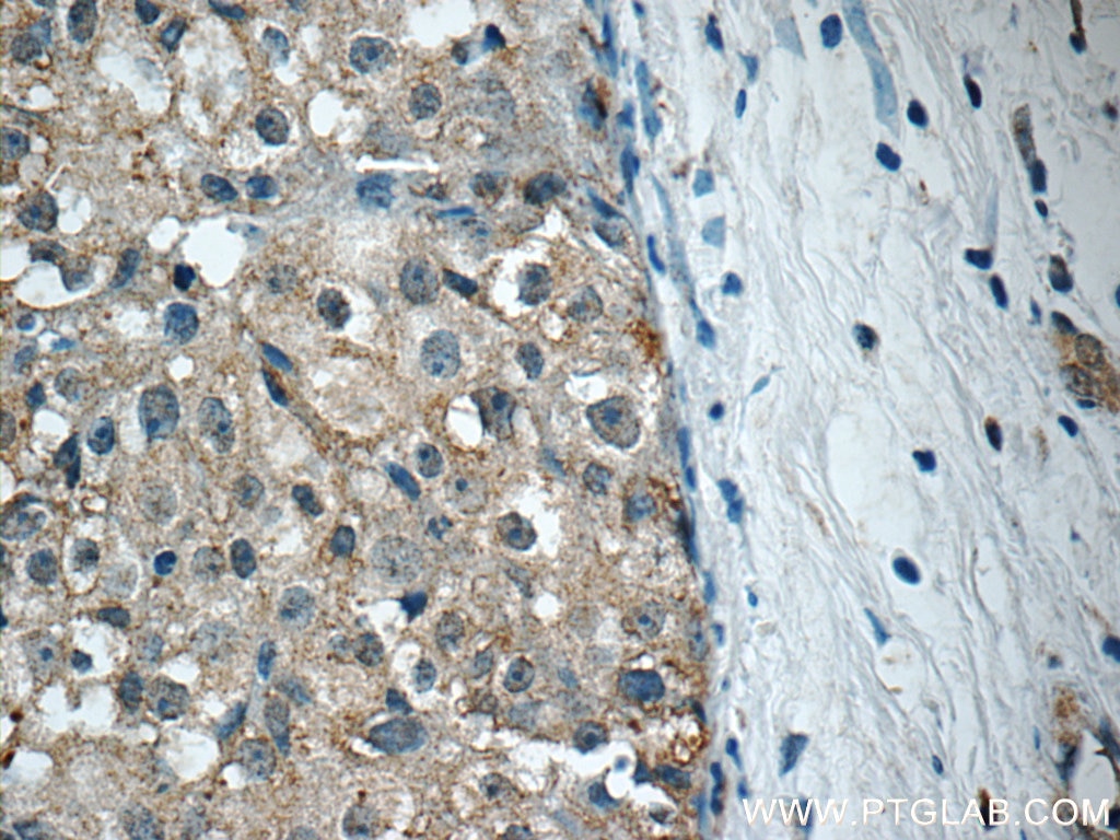 Immunohistochemistry (IHC) staining of human breast cancer tissue using RPS26 Polyclonal antibody (14909-1-AP)