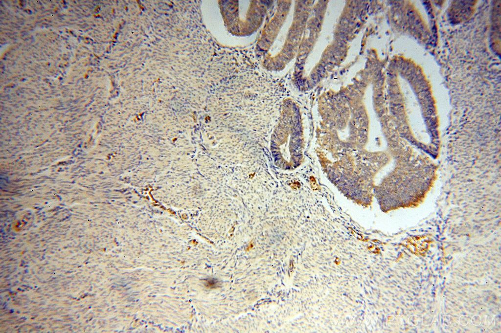 Immunohistochemistry (IHC) staining of human endometrial cancer tissue using RPS27 Polyclonal antibody (15355-1-AP)