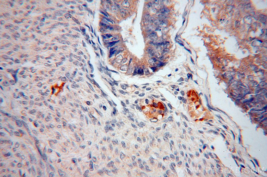 IHC staining of human endometrial cancer using 15355-1-AP