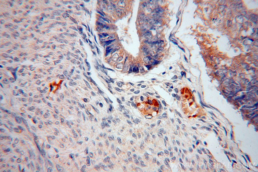 Immunohistochemistry (IHC) staining of human endometrial cancer tissue using RPS27 Polyclonal antibody (15355-1-AP)