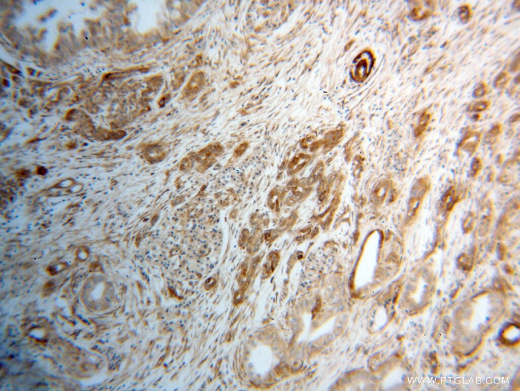 Immunohistochemistry (IHC) staining of human pancreas cancer tissue using RPS28 Polyclonal antibody (14796-1-AP)