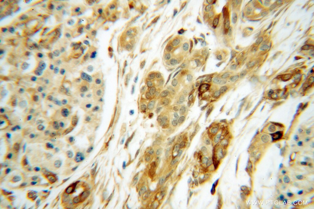 IHC staining of human pancreas cancer using 14796-1-AP