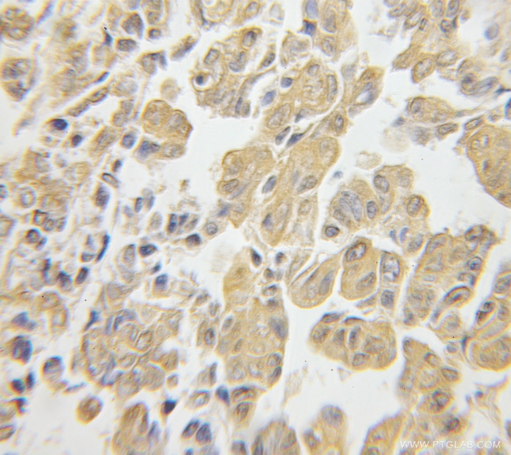 IHC staining of human ovary tumor using 11990-1-AP