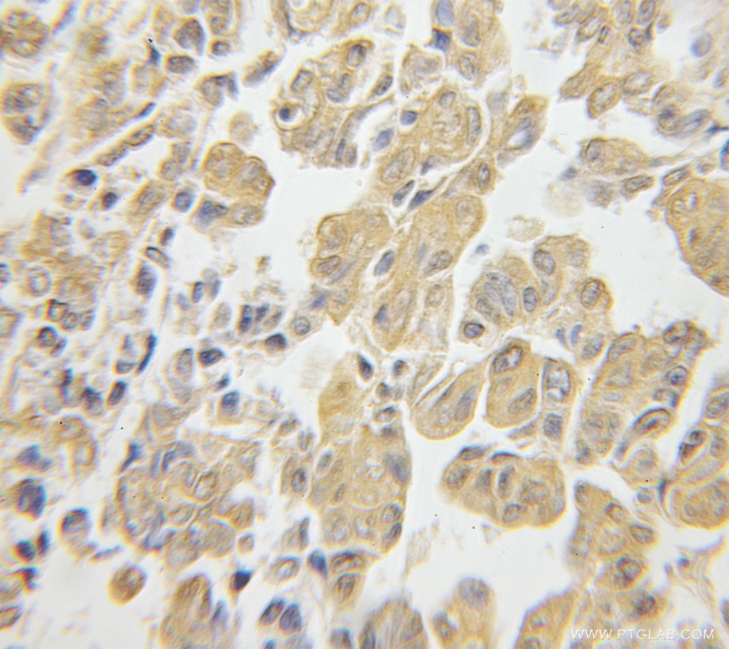 Immunohistochemistry (IHC) staining of human ovary tumor tissue using RPS3 Polyclonal antibody (11990-1-AP)